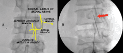 Cervical Facet Rfa SHIVAM HOSPITAL